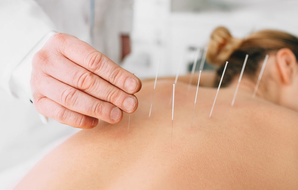 acupuncture